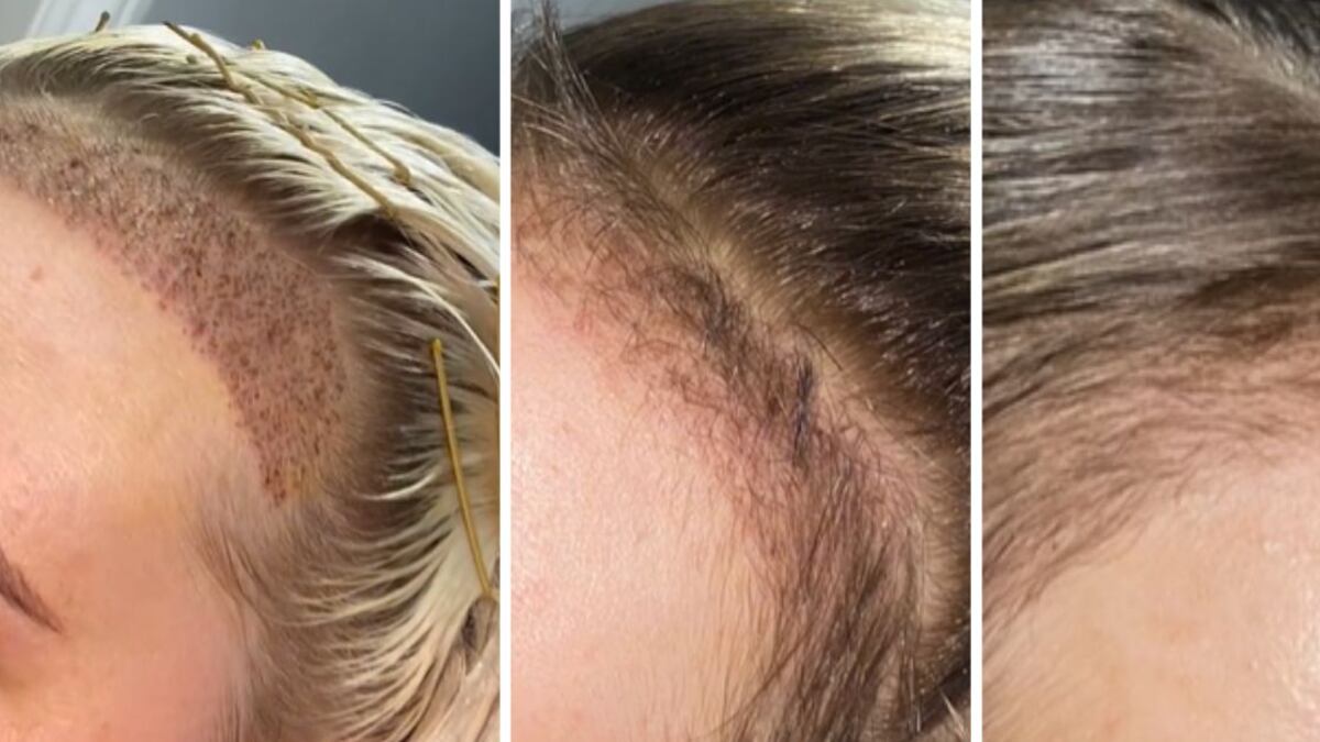 La joven compartió varios videos en la red TikTok, donde mostró el proceso semana a semana de cómo le creció su pelo tras el trasplante.