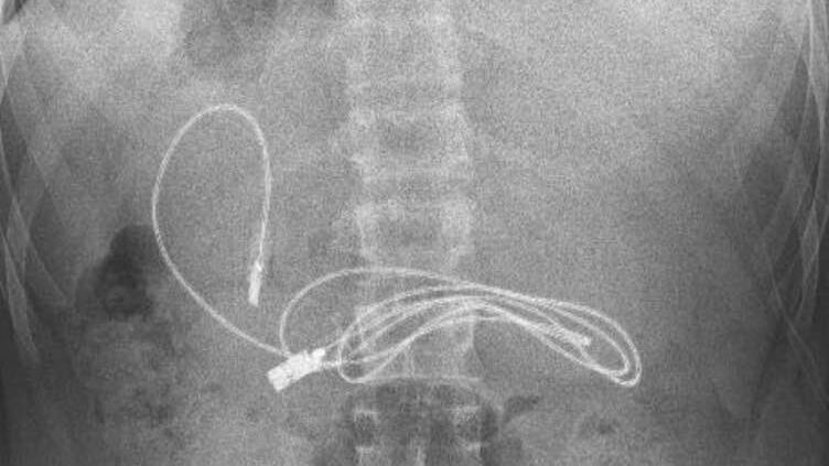 Cable USB en el interior del estomago