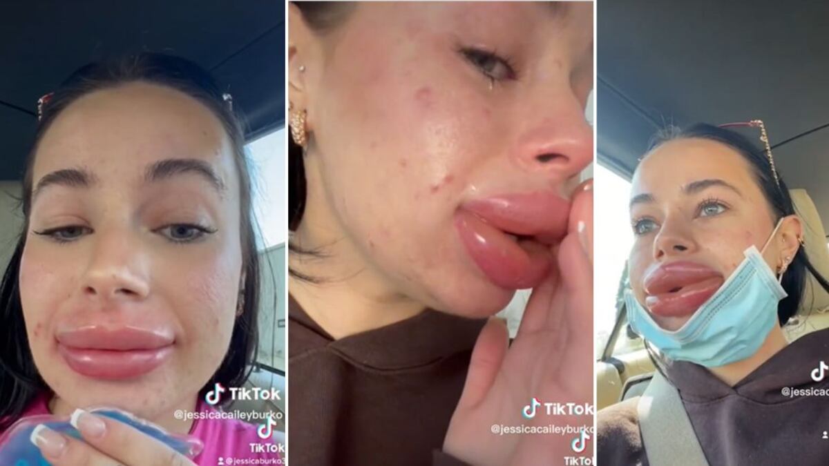 A Jessica Burko se le generó una grave reacción alérgica al procedimiento y sus labios se hincharon enormemente
