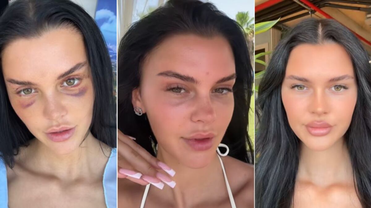 Mujer se hace cirugía para quedar con "ojos de zorro" y el impactante resultado generó debate en redes