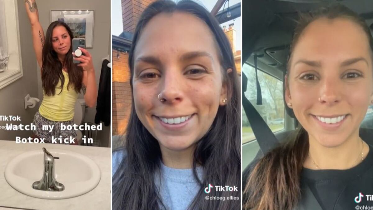 Chloe recibió comentarios de persona que se solidarizaron con ella y aseguran que les pasó lo mismo con el bótox