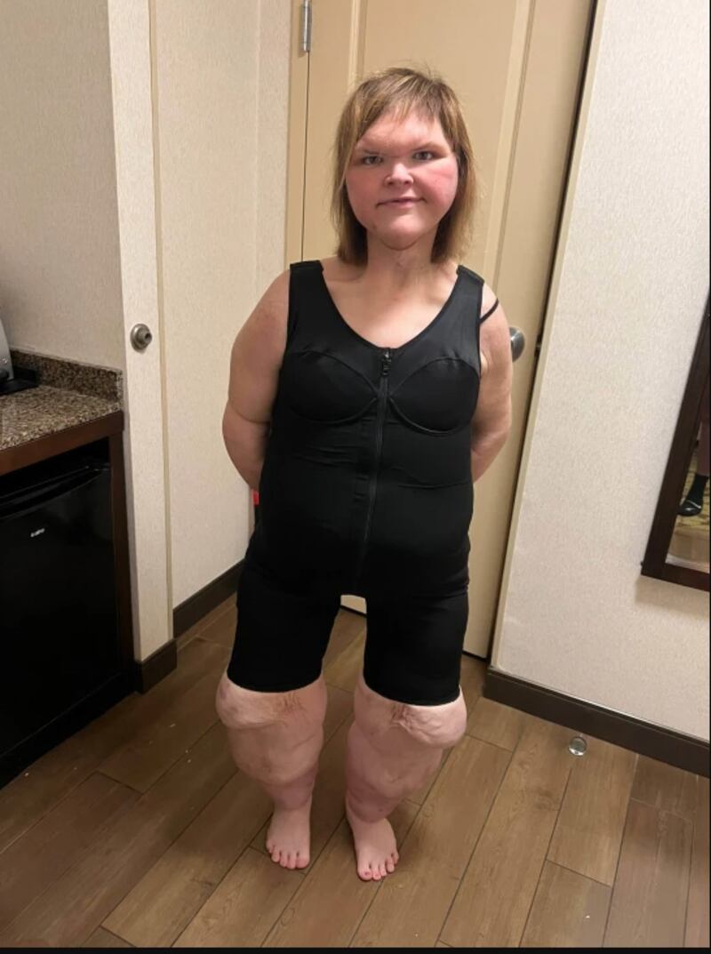 Tammy Slaton tras cirugía