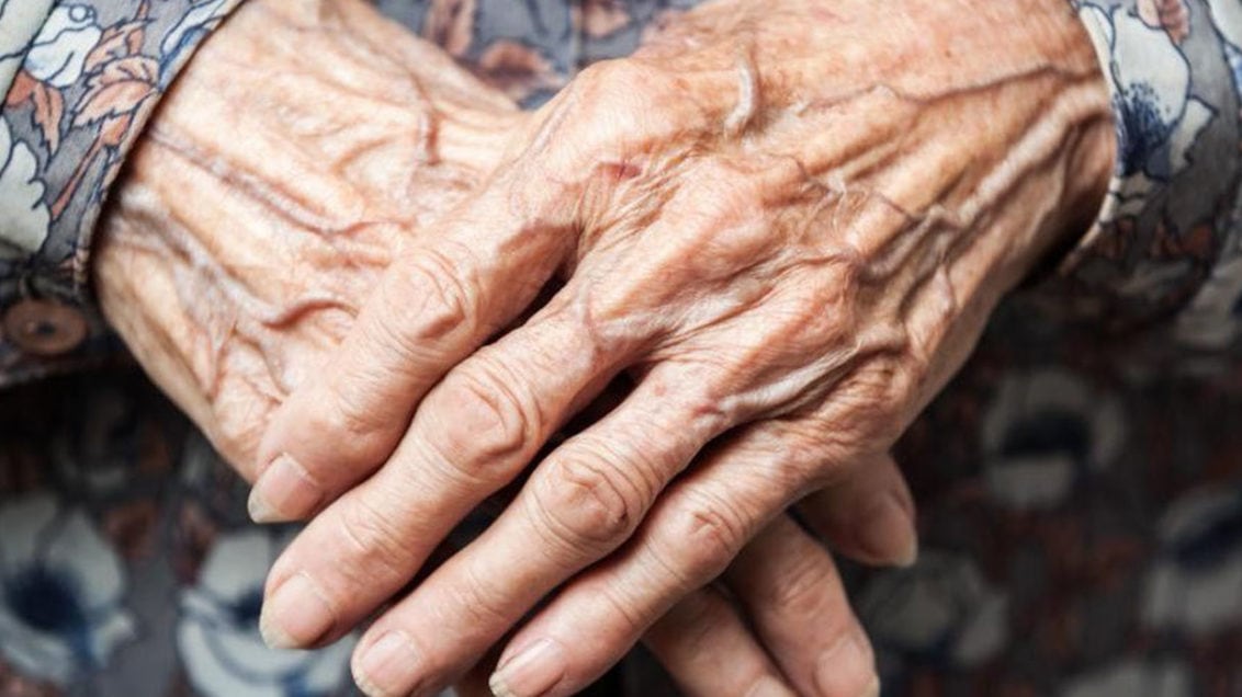 Las menopausia es una de las causas de las manchas en las manos.