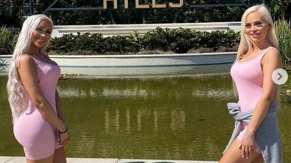 Las gemelas Daisy y Dolly quieren hacerse más operaciones para ser como Barbie