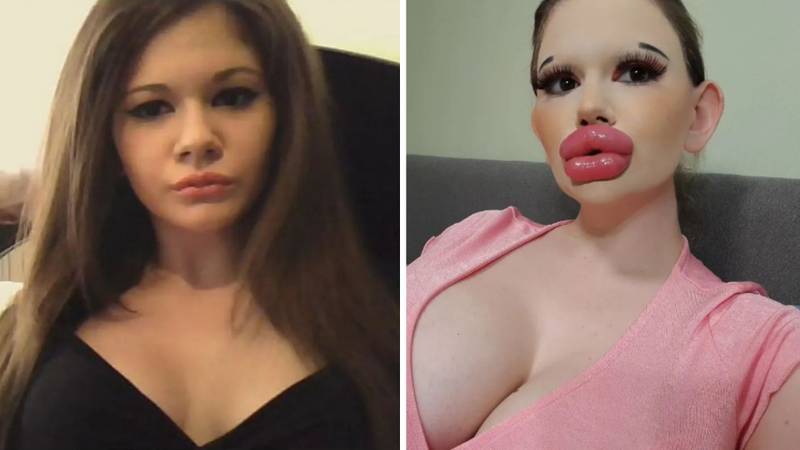 Una joven búlgara se ha inyectado los labios 30 veces con ácido hialurónico.
